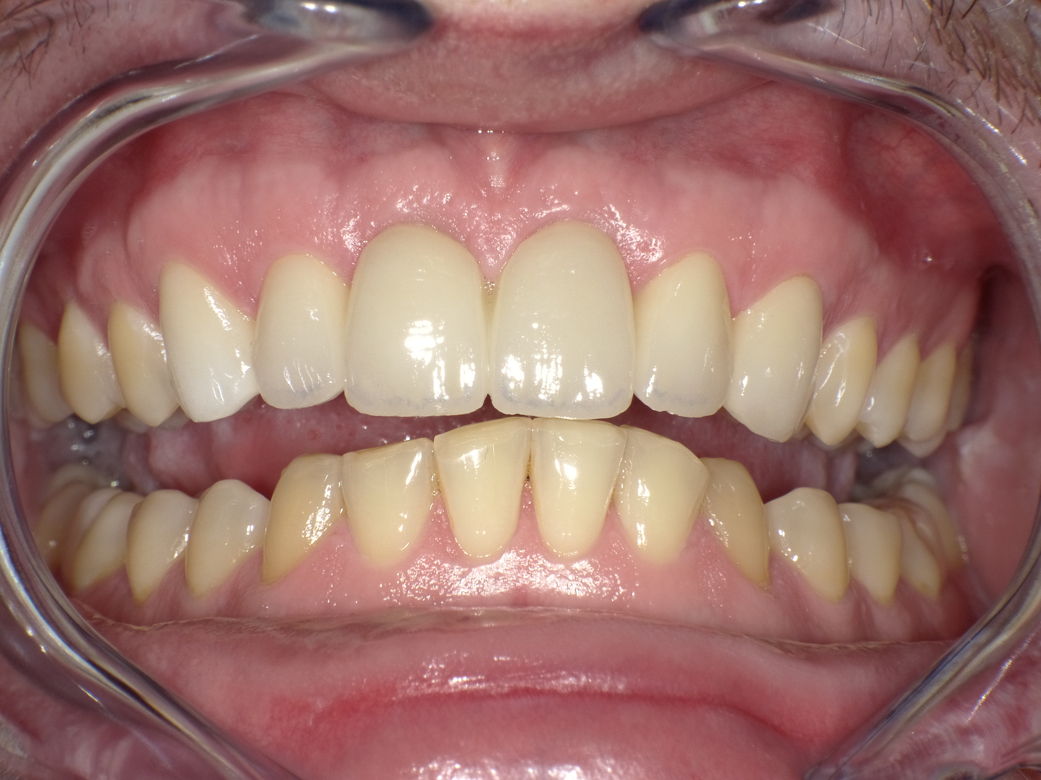 Korrektur durch 2 Implantate mit Knochenumbau in der Mitte und vollkeramische Kronen von Eckzahn bis Eckzahn 